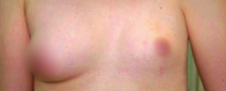 遗传激素水平异常与母乳分泌_遗传性乳腺发育不良影响泌乳量_泌乳期产奶量