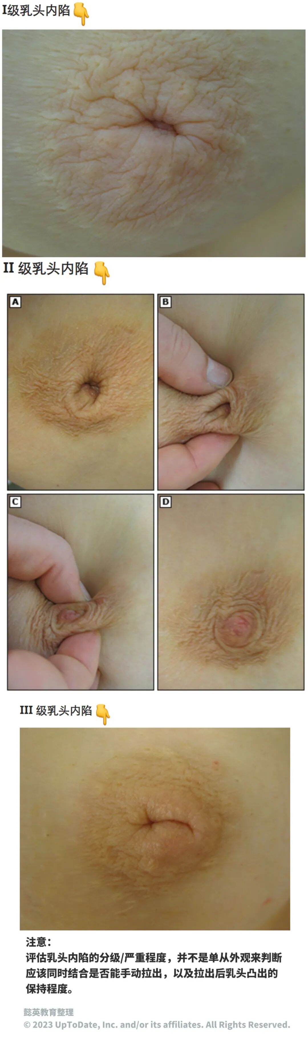 遗传性乳腺发育不良影响泌乳量_泌乳期产奶量_遗传激素水平异常与母乳分泌